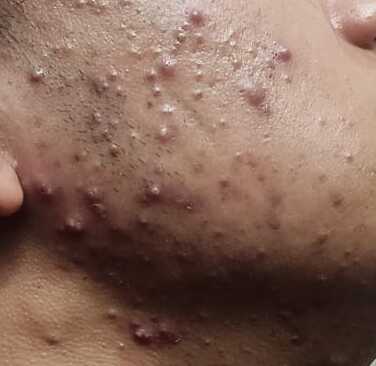 severe acne
