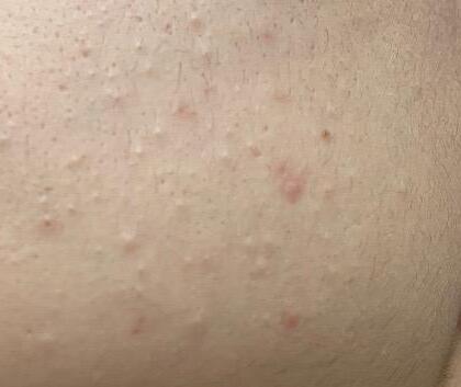 mild to moderate acne
