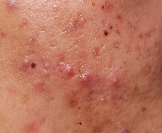 moderate acne