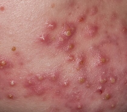 severe acne