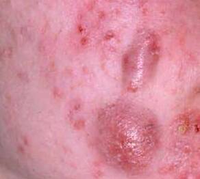 very severe acne